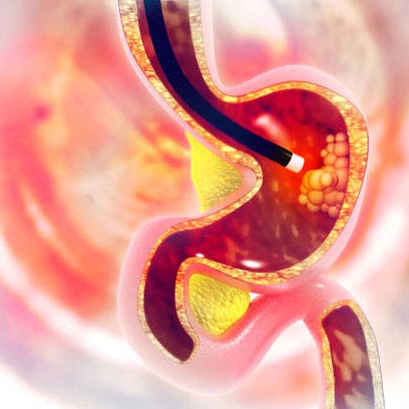 endoscopy